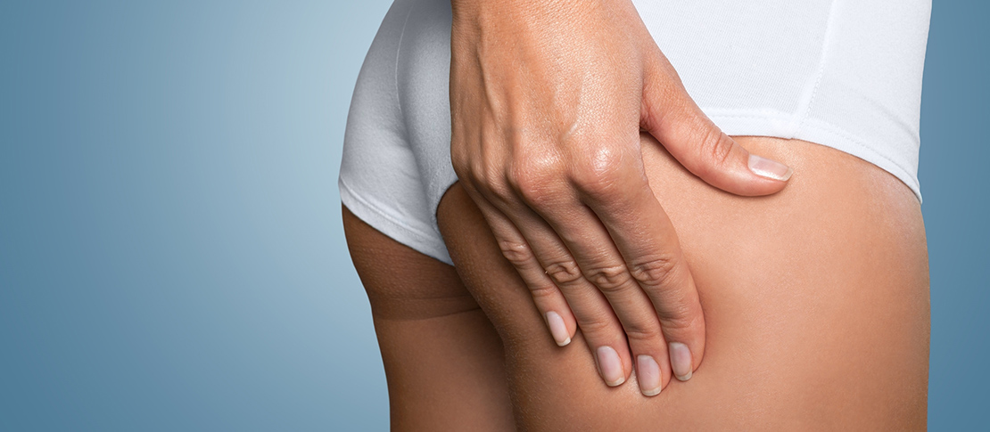 Celulitis: Qué Es, Por Qué Aparece Y Cómo Mejorar El Aspecto De La Piel 11 Que Es La Celulitis
